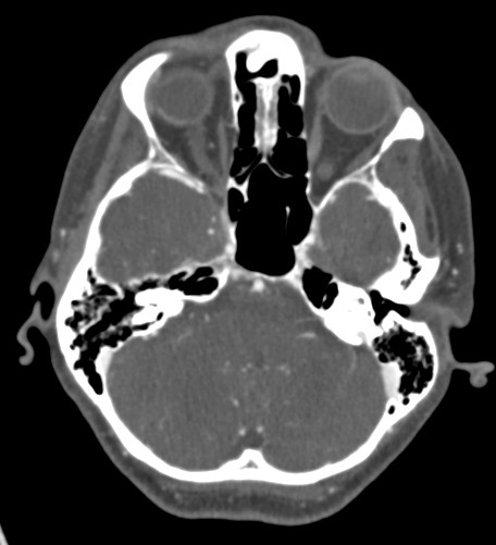 Basilar tip aneurysm with coiling (Radiopaedia 53912-60086 A 40).jpg