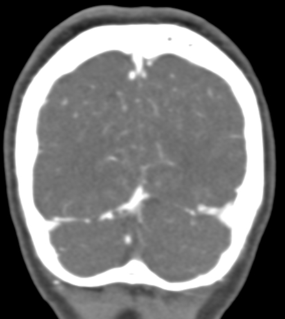 File:Basilar tip aneurysm with coiling (Radiopaedia 53912-60086 B 137).jpg