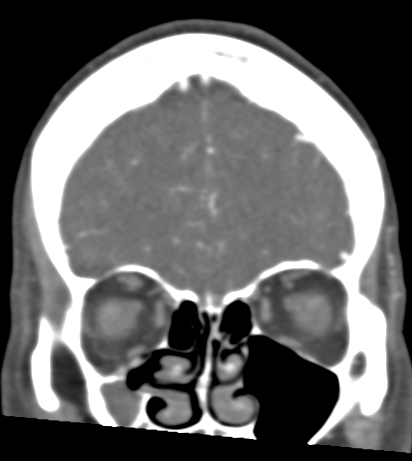 Basilar tip aneurysm with coiling (Radiopaedia 53912-60086 B 25).jpg