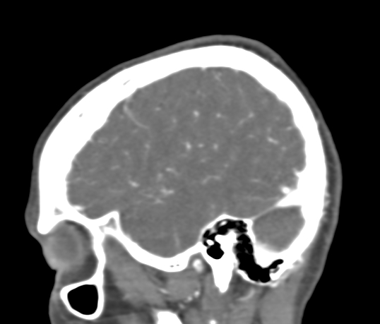 Basilar tip aneurysm with coiling (Radiopaedia 53912-60086 C 21).jpg