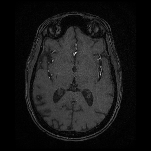 Basilar top and left middle cerebral artery aneurysm (Radiopaedia 61965-70031 Axial MRA 85).jpg