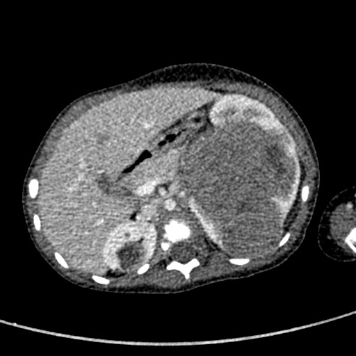 Beckwith-Wiedeman syndrome with bilateral Wilms tumors (Radiopaedia 60850-68629 A 53).jpg