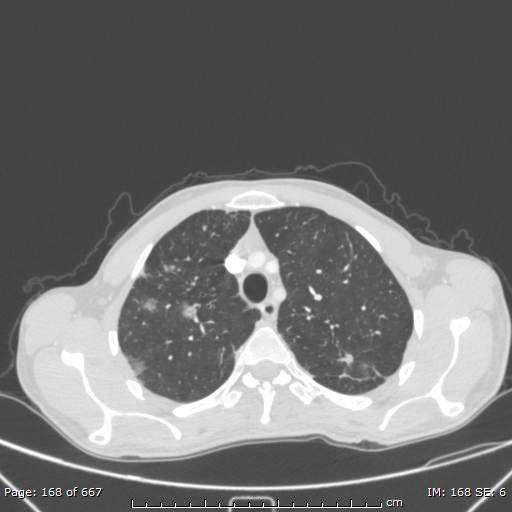 Behçet disease (Radiopaedia 44247-47889 Axial lung window 18).jpg