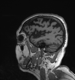 Behavioral variant frontotemporal dementia and late onset schizophrenia (Radiopaedia 52197-58083 Sagittal T1 11).png