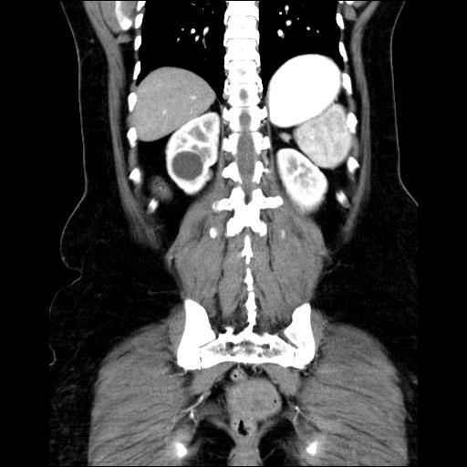File:Benign spindle cell tumor - abdominopelvic (Radiopaedia 61300-69212 C 42).jpg