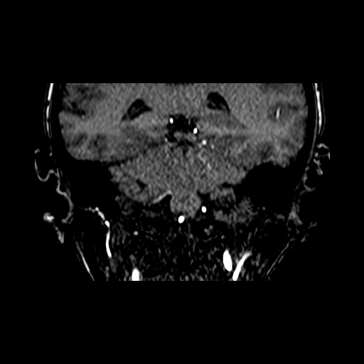 Berry aneurysm of the terminal internal carotid artery (Radiopaedia 88286-104918 Coronal TOF 71).jpg