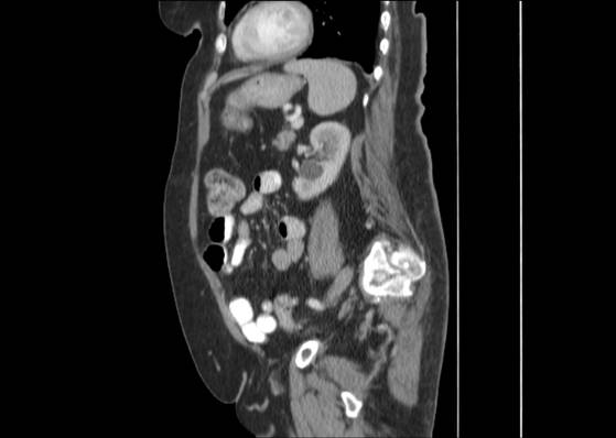 File:Bicameral celiacomesenteric aneurysm (Radiopaedia 55766-62327 B 39).jpg
