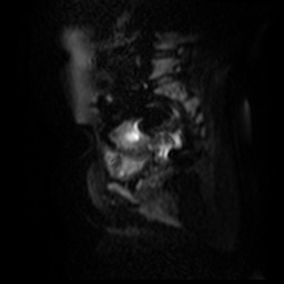 File:Bicornuate uterus (Radiopaedia 51676-57472 Sagittal DWI 11).jpg