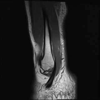 File:Bilateral Achilles tendon complete tear (Radiopaedia 81344-95051 Sagittal T1 2).jpg