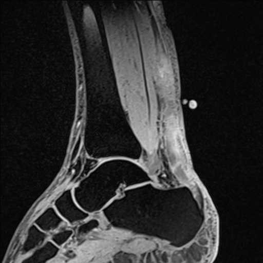 Bilateral Achilles tendon complete tear (Radiopaedia 81344-95051 Sagittal WE - Left 56).jpg