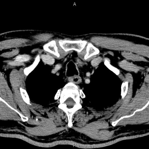 File:Bilateral Warthin tumors (Radiopaedia 84034-99263 Axial With contrast 66).jpg