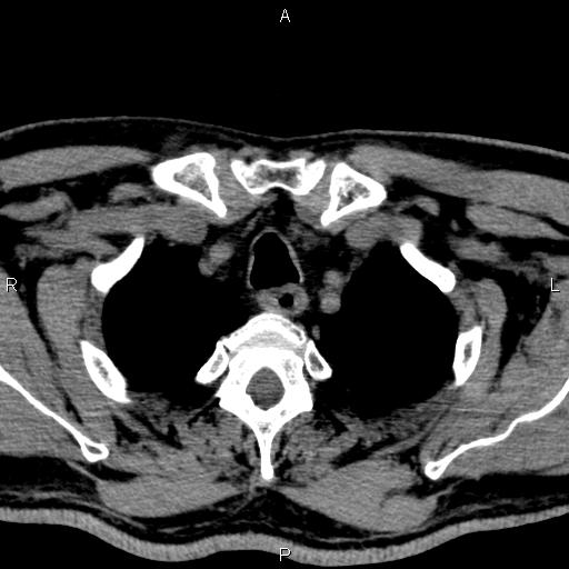 Bilateral Warthin tumors (Radiopaedia 84034-99263 Axial non-contrast 63).jpg