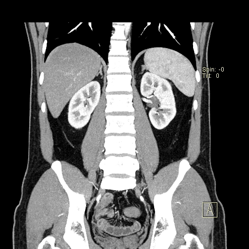 File:Bilateral accessory renal arteries with mild pelvi-ureteric junction (PUJ) obstruction (Radiopaedia 66357-75596 B 35).jpg