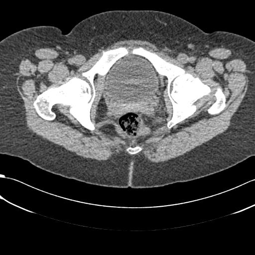Bilateral acetabular protrusion with pincer type femoro-acetabular impingement (Radiopaedia 30134-30733 AXIAL SOFT THIN 54).jpg