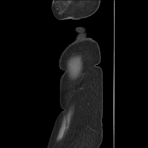 File:Bilateral adrenal granulocytic sarcomas (chloromas) (Radiopaedia 78375-91007 C 132).jpg