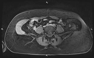 File:Bilateral adrenal myelolipoma (Radiopaedia 63058-71537 H 78).jpg