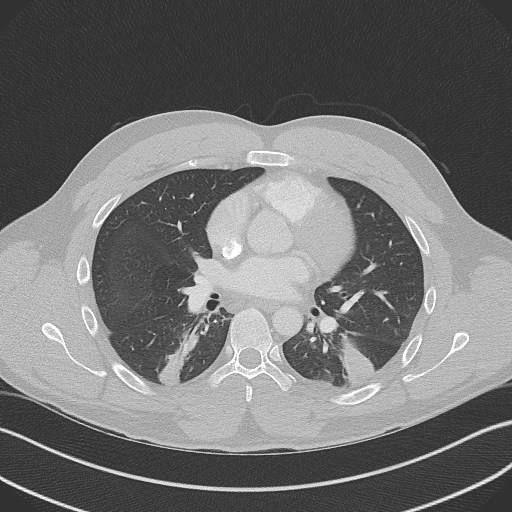 Bilateral atelectasis (Radiopaedia 48666-53675 Axial lung window 59).jpg