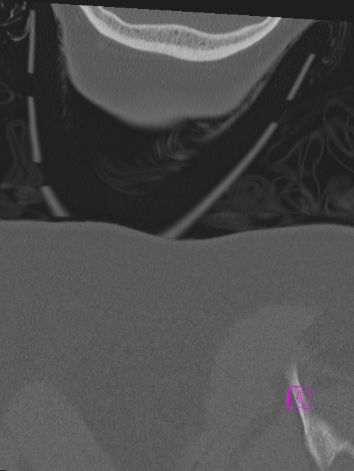 Bilateral atlanto-occipital assimilation (Radiopaedia 28350-28603 Coronal bone window 68).jpg