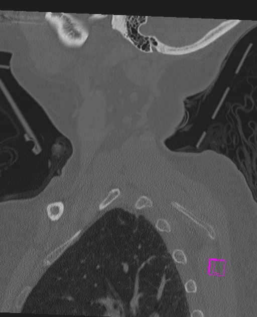 Bilateral atlanto-occipital assimilation (Radiopaedia 28350-28603 Sagittal bone window 9).jpg