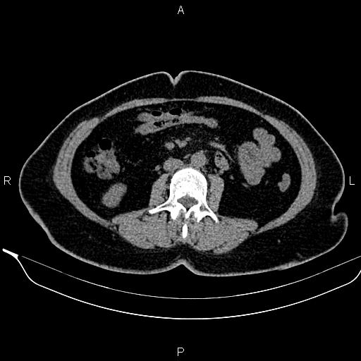 Bilateral benign adrenal adenomas (Radiopaedia 86912-103124 Axial non-contrast 60).jpg
