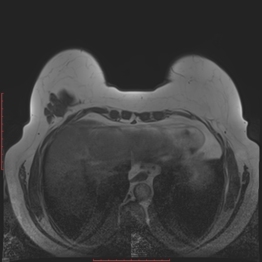 File:Bilateral breast implant rupture (Radiopaedia 24761-25027 T1 31).jpg