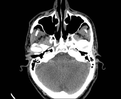 Bilateral carotid body tumors (Radiopaedia 61841-69870 Axial non-contrast 1).jpg
