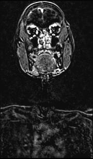Bilateral carotid body tumors and right glomus jugulare tumor (Radiopaedia 20024-20060 MRA 74).jpg