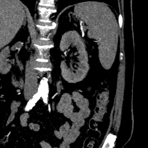 File:Bilateral delayed nephrogram from renal artery stenosis (Radiopaedia 47681-52362 B 13).png