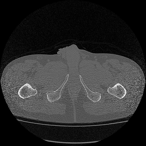 Bilateral femoral neck stress fractures (Radiopaedia 28666-28954 Axial bone window 89).png