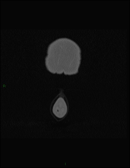 Bilateral frontal mucoceles (Radiopaedia 82352-96454 Coronal 11).jpg