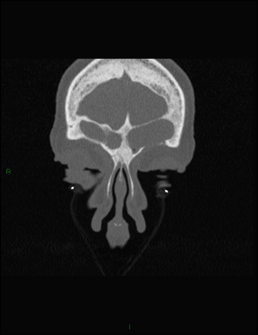 Bilateral frontal mucoceles (Radiopaedia 82352-96454 Coronal 59).jpg