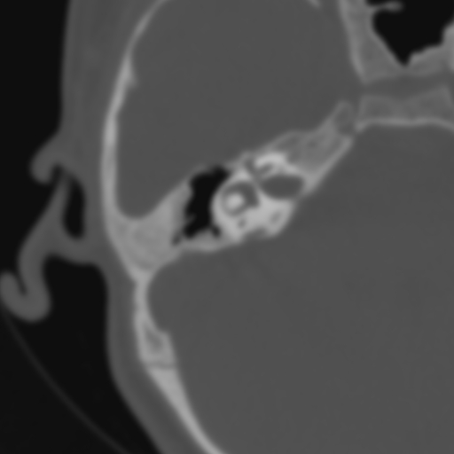 Bilateral otosclerosis (Radiopaedia 57237-64157 B 65).jpg
