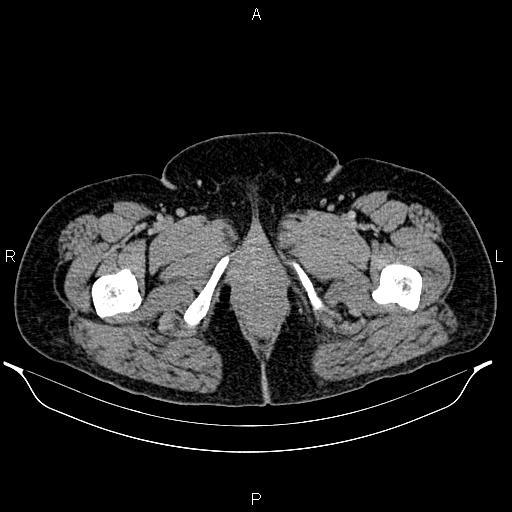 File:Bilateral ovarian dermoid cysts (Radiopaedia 85785-101603 A 117).jpg
