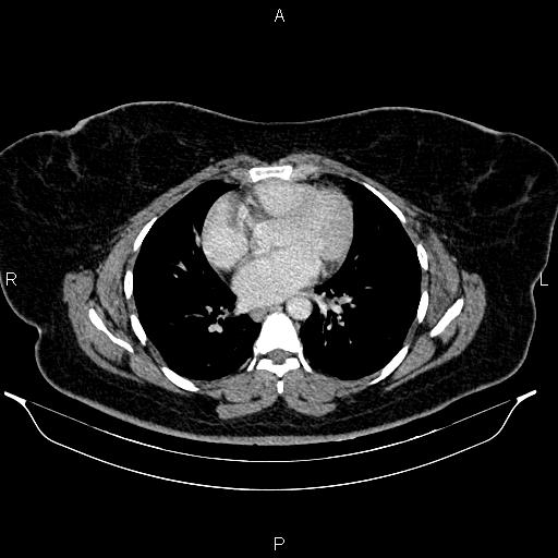 Bilateral ovarian dermoid cysts (Radiopaedia 85785-101603 A 2).jpg