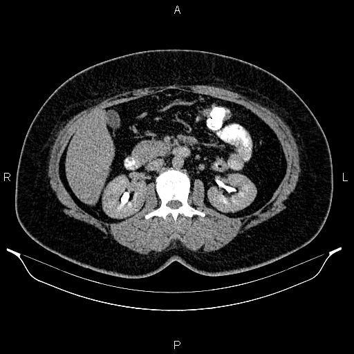 File:Bilateral ovarian dermoid cysts (Radiopaedia 85785-101603 Axial C+ delayed 28).jpg