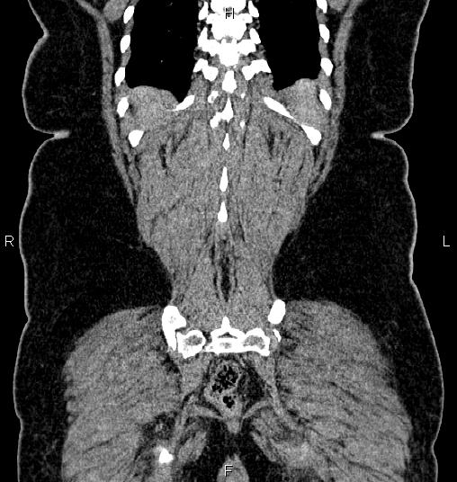 Bilateral ovarian dermoid cysts (Radiopaedia 85785-101603 C 54).jpg