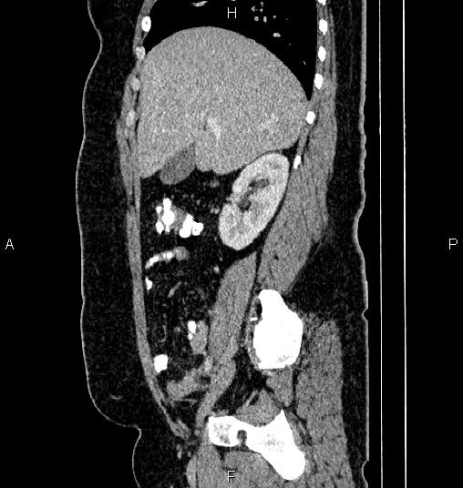 File:Bilateral ovarian dermoid cysts (Radiopaedia 85785-101603 D 26).jpg