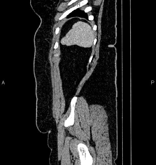 Bilateral ovarian dermoid cysts (Radiopaedia 85785-101603 D 87).jpg