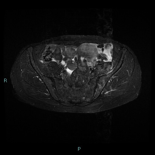 File:Bilateral ovarian fibroma (Radiopaedia 44568-48293 Axial STIR 8).jpg