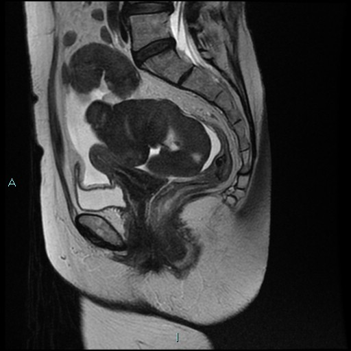 File:Bilateral ovarian fibroma (Radiopaedia 44568-48293 Sagittal T2 19).jpg