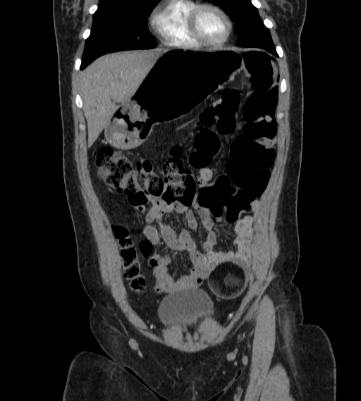 Bilateral ovarian mature cystic teratomas (Radiopaedia 79373-92457 B 9).jpg