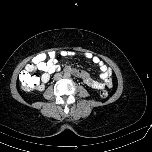 File:Bilateral ovarian serous cystadenocarcinoma (Radiopaedia 86062-101989 Axial C+ delayed 39).jpg