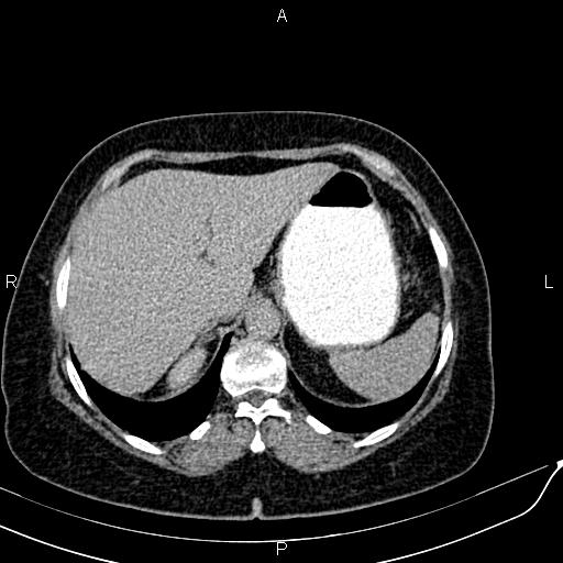 Bilateral ovarian serous cystadenocarcinoma (Radiopaedia 86062-101989 Axial C+ delayed 6).jpg