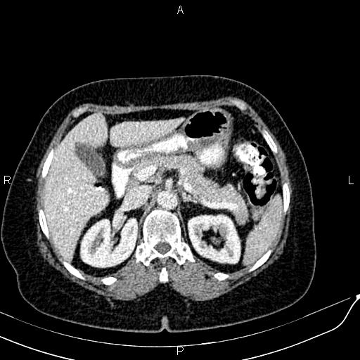 Bilateral ovarian serous cystadenocarcinoma (Radiopaedia 86062-101989 B 31).jpg