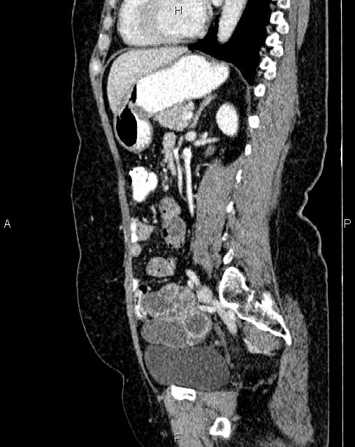 Bilateral ovarian serous cystadenocarcinoma (Radiopaedia 86062-101989 E 53).jpg