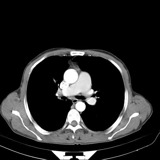Bilateral parotid gland lymphoma (Radiopaedia 21038-20969 A 33).jpg