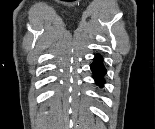 Bilateral pulmonary AVM (Radiopaedia 83134-97505 C 71).jpg