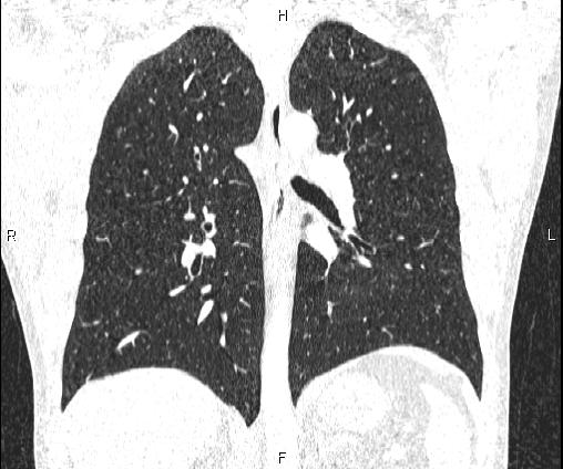 Bilateral pulmonary AVM (Radiopaedia 83134-97505 Coronal lung window 50).jpg