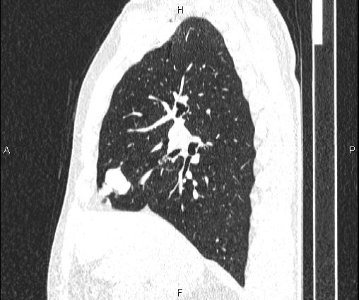 Bilateral pulmonary AVM (Radiopaedia 83134-97505 Sagittal lung window 48).jpg