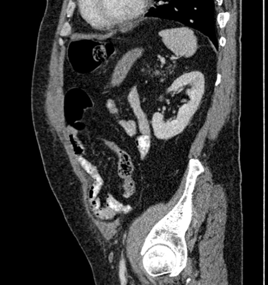 File:Bilateral rectus sheath hematomas (Radiopaedia 50778-56252 B 59).jpg